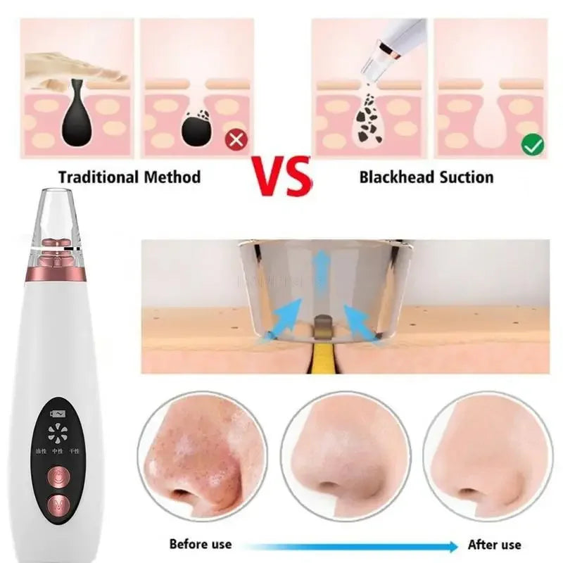 USB Charging Face Pore Vacuum Blackhead & Acne Remover Deep Cleansing Skin Care Tool with Black Dot Cleaner for Pimple Removal